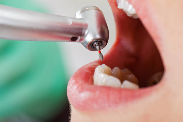 Best Emergency Root Canal Treatment in Cicero, IL